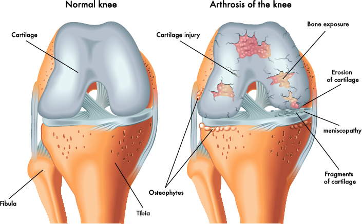 ortopedia rigenerativa per artrosi