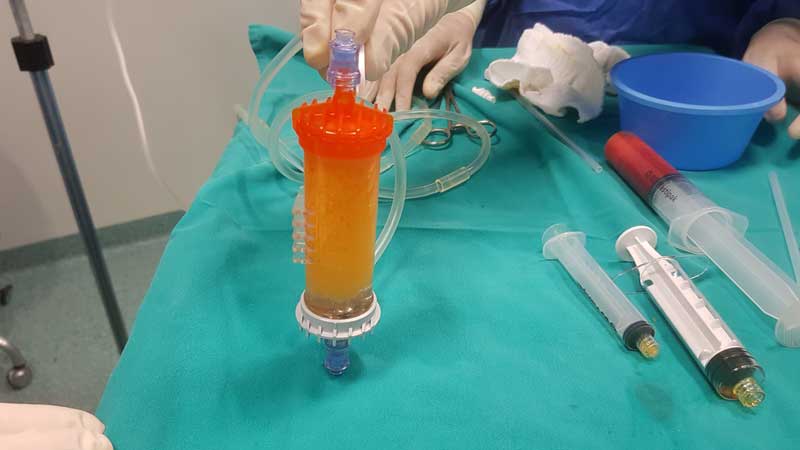 preparazione lipogems